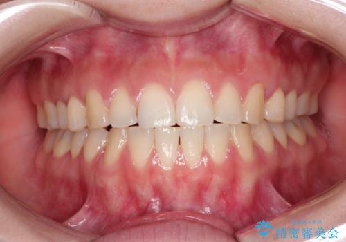 上下の前歯が当たらない　インビザラインによる開咬の矯正治療の治療後