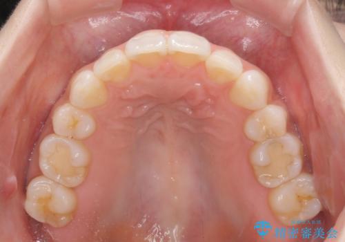 矯正治療の後戻り インビザラインによる再矯正治療の治療後