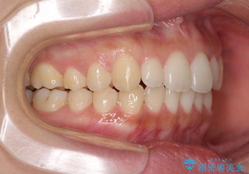 海外勤務中でも矯正治療 インビザラインによる軽度叢生改善の治療中