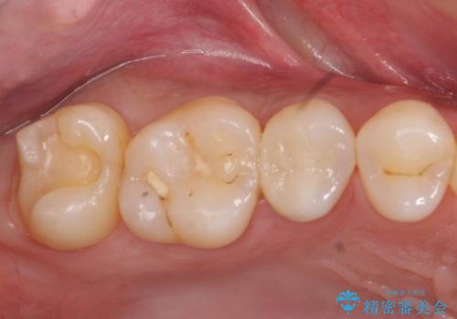 奥歯の虫歯 セラミックインレーにの治療中