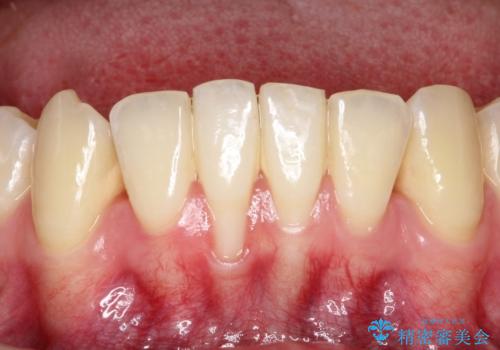 下顎前歯の歯肉退縮　結合組織を用いた根面被覆の治療前