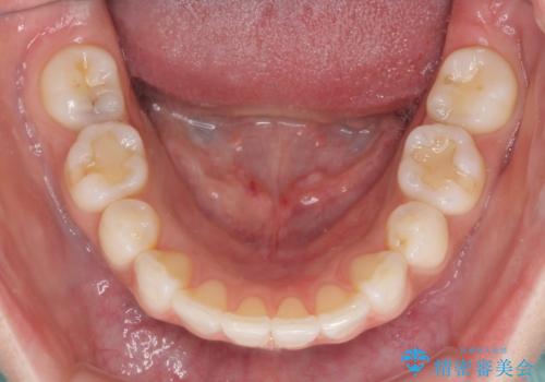 矯正治療の後戻り インビザラインによる再矯正治療の治療後