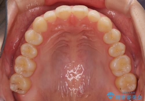海外勤務中でも矯正治療 インビザラインによる軽度叢生改善の治療中