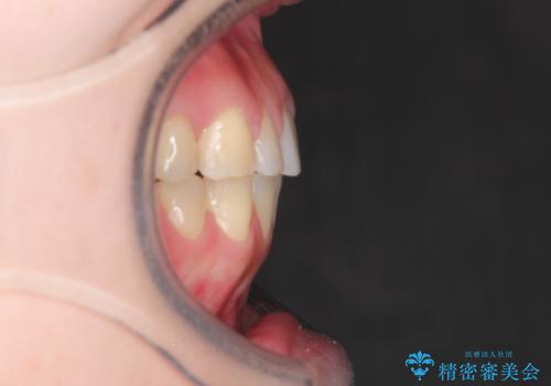 上下の前歯が当たらない インビザラインによる開咬の矯正治療の治療後