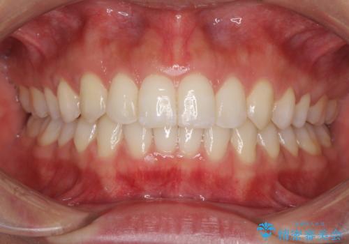 ディープバイトと前歯のデコボコを治したい インビザラインによる矯正治療の症例 治療後