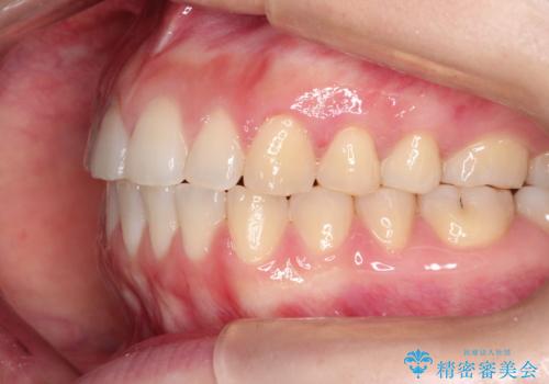 上下の前歯が当たらない インビザラインによる開咬の矯正治療の治療後
