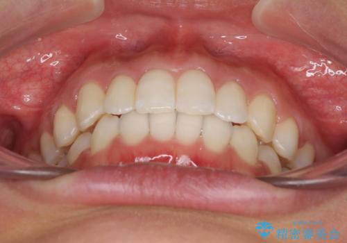 ディープバイトと前歯のデコボコを治したい インビザラインによる矯正治療の治療後