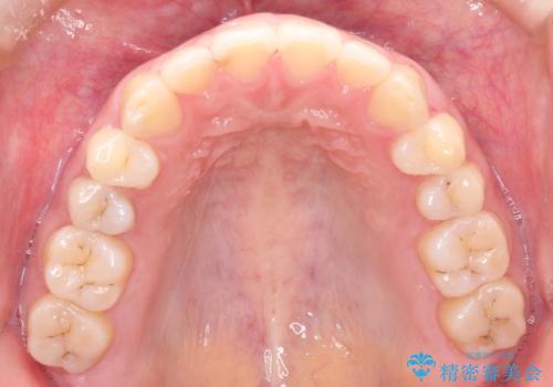 上下の前歯が当たらない　インビザラインによる開咬の矯正治療の治療後