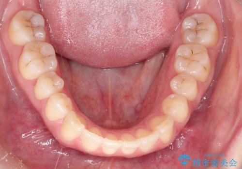 上下の前歯が当たらない インビザラインによる開咬の矯正治療の治療後