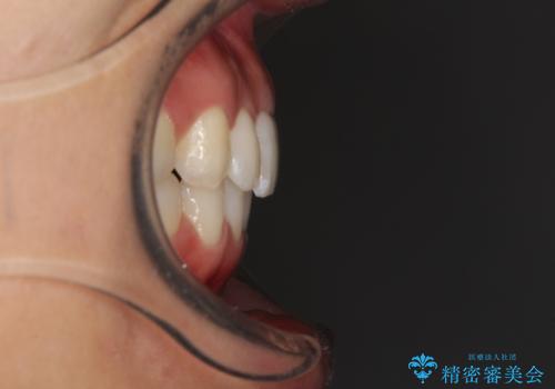 ディープバイトと前歯のデコボコを治したい インビザラインによる矯正治療の治療後