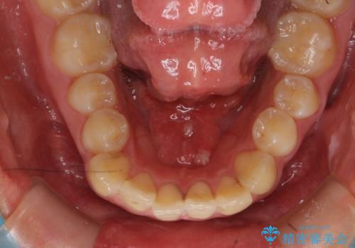 舌が持ち上がらない 舌小帯切除の治療後