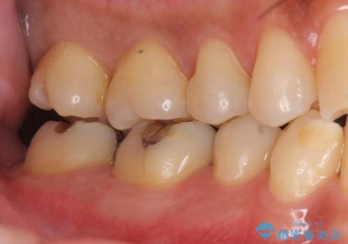 奥歯の虫歯 セラミックインレーにの治療中