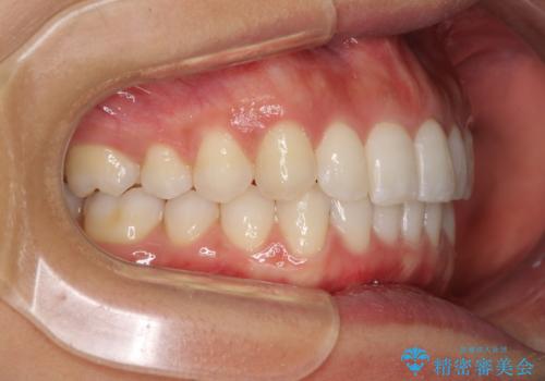ディープバイトと前歯のデコボコを治したい インビザラインによる矯正治療の治療後