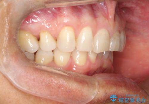 上の前歯の隙間とがたつきをインビザラインできれいな歯並びへの治療後