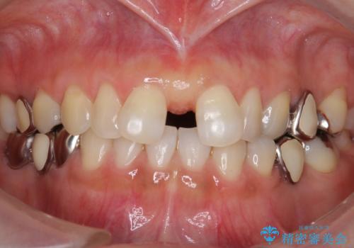 大人の上唇小帯切除 前歯のすき間の原因になりますの治療後