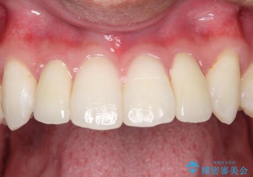 矮小歯(通常より小さな歯)をオールセラミックを装着して自然な歯への症例 治療後