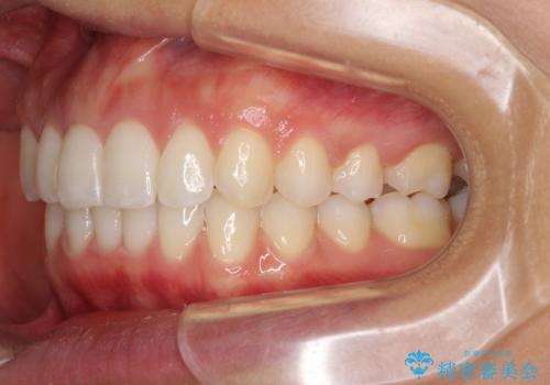 ディープバイトと前歯のデコボコを治したい インビザラインによる矯正治療の治療後