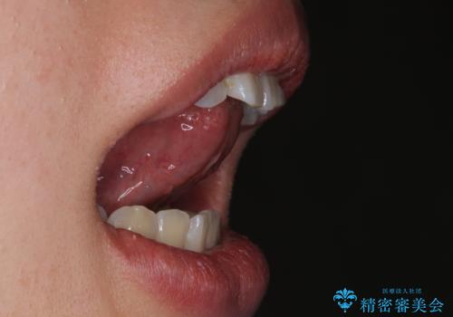 舌が持ち上がらない　舌小帯切除の治療後