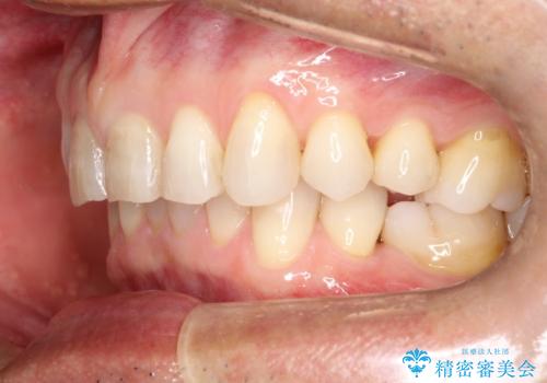 上の前歯の隙間とがたつきをインビザラインできれいな歯並びへの治療後
