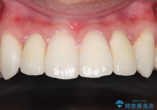 矮小歯(通常より小さな歯)をオールセラミックを装着して自然な歯への治療後