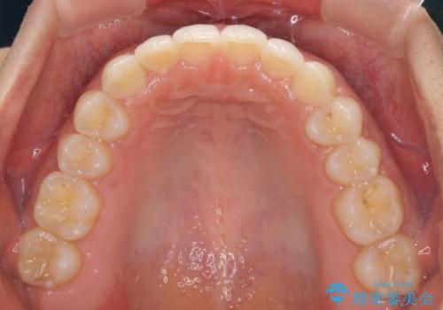 ディープバイトと前歯のデコボコを治したい インビザラインによる矯正治療の治療後