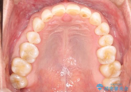 上の前歯の隙間とがたつきをインビザラインできれいな歯並びへの治療後