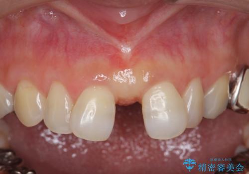 大人の上唇小帯切除　前歯のすき間の原因になりますの治療後
