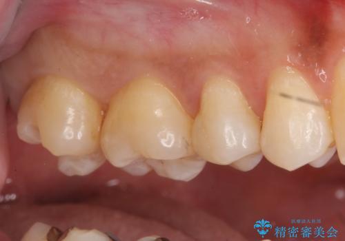 奥歯の虫歯 セラミックインレーにの治療中