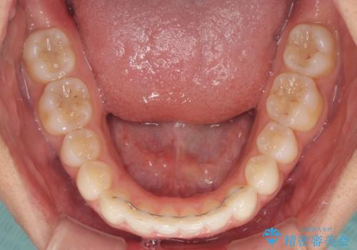 ディープバイトと前歯のデコボコを治したい インビザラインによる矯正治療の治療後