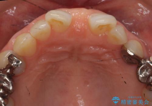 大人の上唇小帯切除　前歯のすき間の原因になりますの治療後