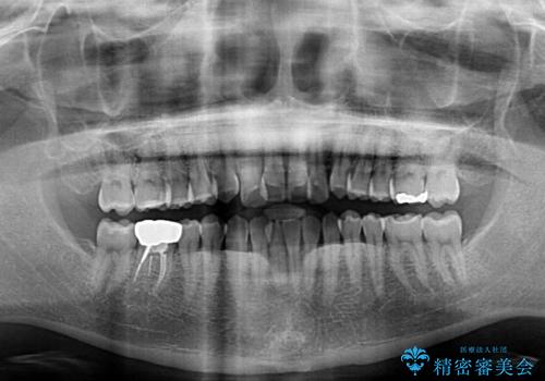 前歯のデコボコを治したい インビザラインによる矯正治療の治療前