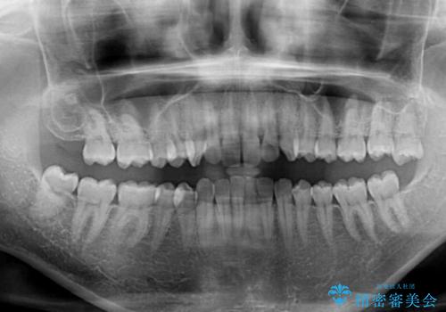ディープバイトと前歯のデコボコを治したい インビザラインによる矯正治療の治療前