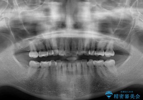 矯正治療の後戻り インビザラインによる再矯正治療の治療前