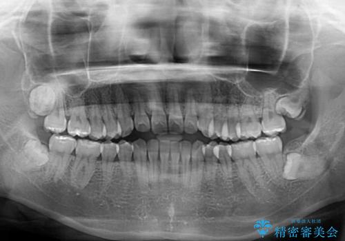 話しにくいオープンバイト インビザラインによる矯正治療の治療前