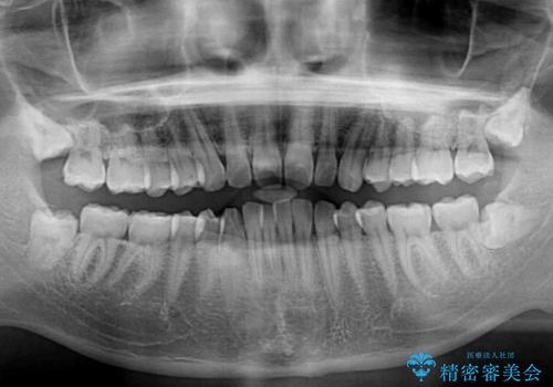 深い咬み合わせと前歯のデコボコの改善　インビザラインによる矯正治療の治療前