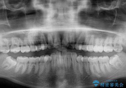 口が閉じられない 抜歯矯正で口元をスッキリとの治療前