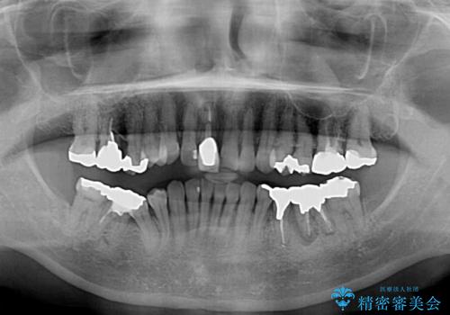 金属を全てセラミックに メタルフリー治療の治療前