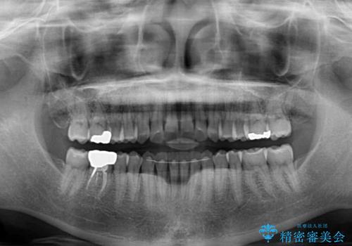 前歯のデコボコを治したい インビザラインによる矯正治療の治療後
