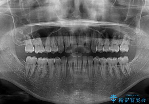 ディープバイトと前歯のデコボコを治したい インビザラインによる矯正治療の治療後