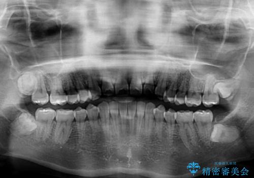 話しにくいオープンバイト インビザラインによる矯正治療の治療後