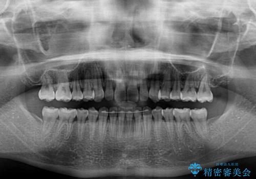 海外勤務中でも矯正治療 インビザラインによる軽度叢生改善の治療後