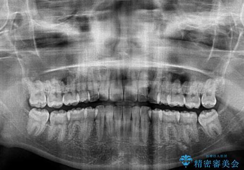 口が閉じられない 抜歯矯正で口元をスッキリとの治療後