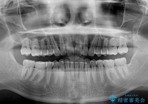 深い咬み合わせと前歯のデコボコの改善 インビザラインによる矯正治療の治療後