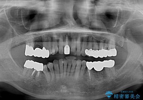 金属を全てセラミックに メタルフリー治療の治療後