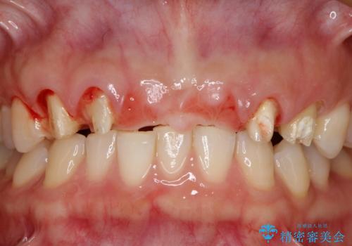 前歯 ブリッジ周囲の腫れた歯ぐきを改善の治療前