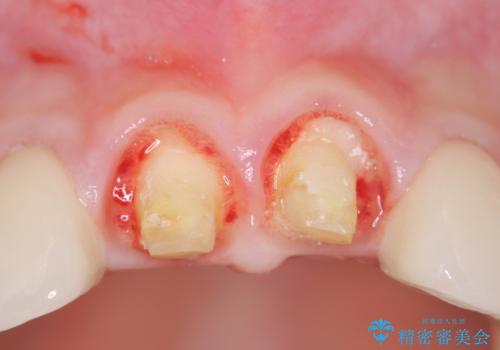 不適合なクラウンのやりかえの治療中