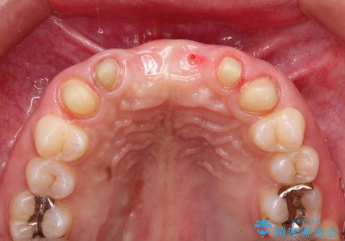前歯 ブリッジ周囲の腫れた歯ぐきを改善の治療中