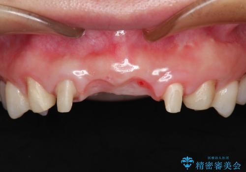 前歯　ブリッジ周囲の腫れた歯ぐきを改善の治療中