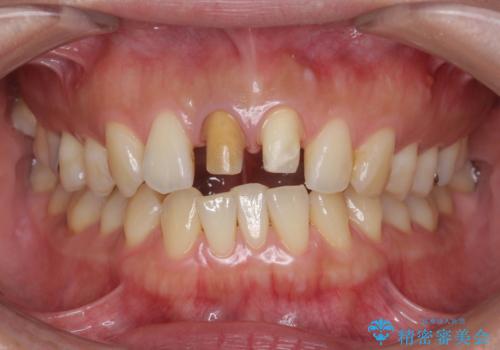前歯の変色　根管治療と高品質セラミック歯科治療の治療中