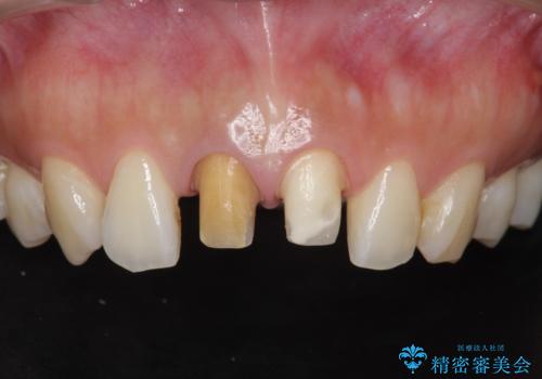 前歯の変色 根管治療と高品質セラミック歯科治療の治療中